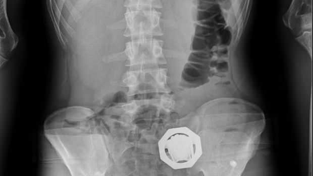 Diyarbakır'da uyuşturucu operasyonu: Midelerinden &ccedil;ıkanlar şoke etti!