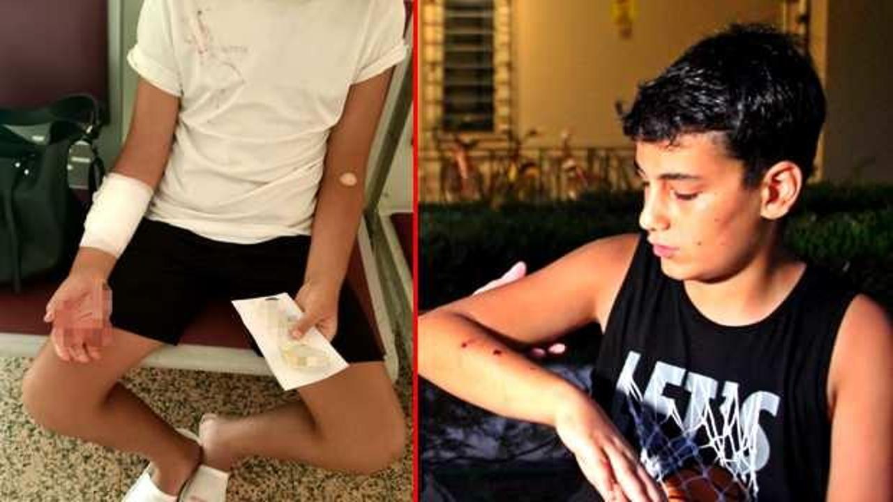 Başıboş sokak k&ouml;peği s&uuml;r&uuml;s&uuml; dehşet sa&ccedil;tı: 12 yaşındaki &ccedil;ocuk hastanelik oldu