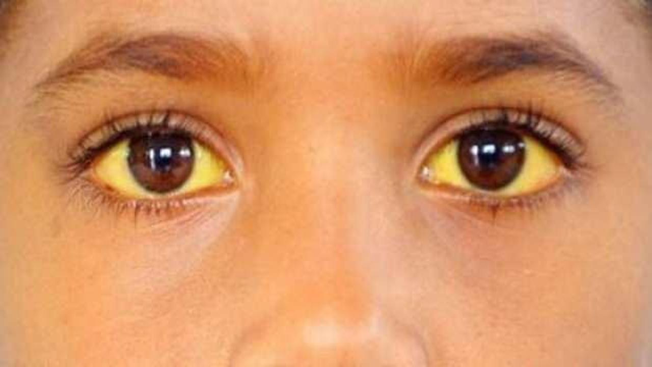 DS&Ouml;'den Gazze i&ccedil;in "Hepatit A" uyarısı