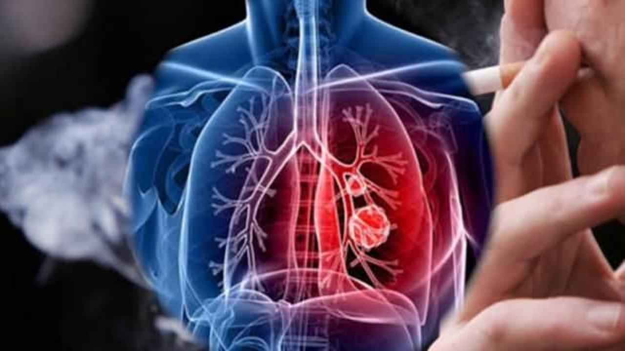 Akciğer kanseri öldürür mü, kurtulma şansı var mı? Akciğer kanseri belirtileri