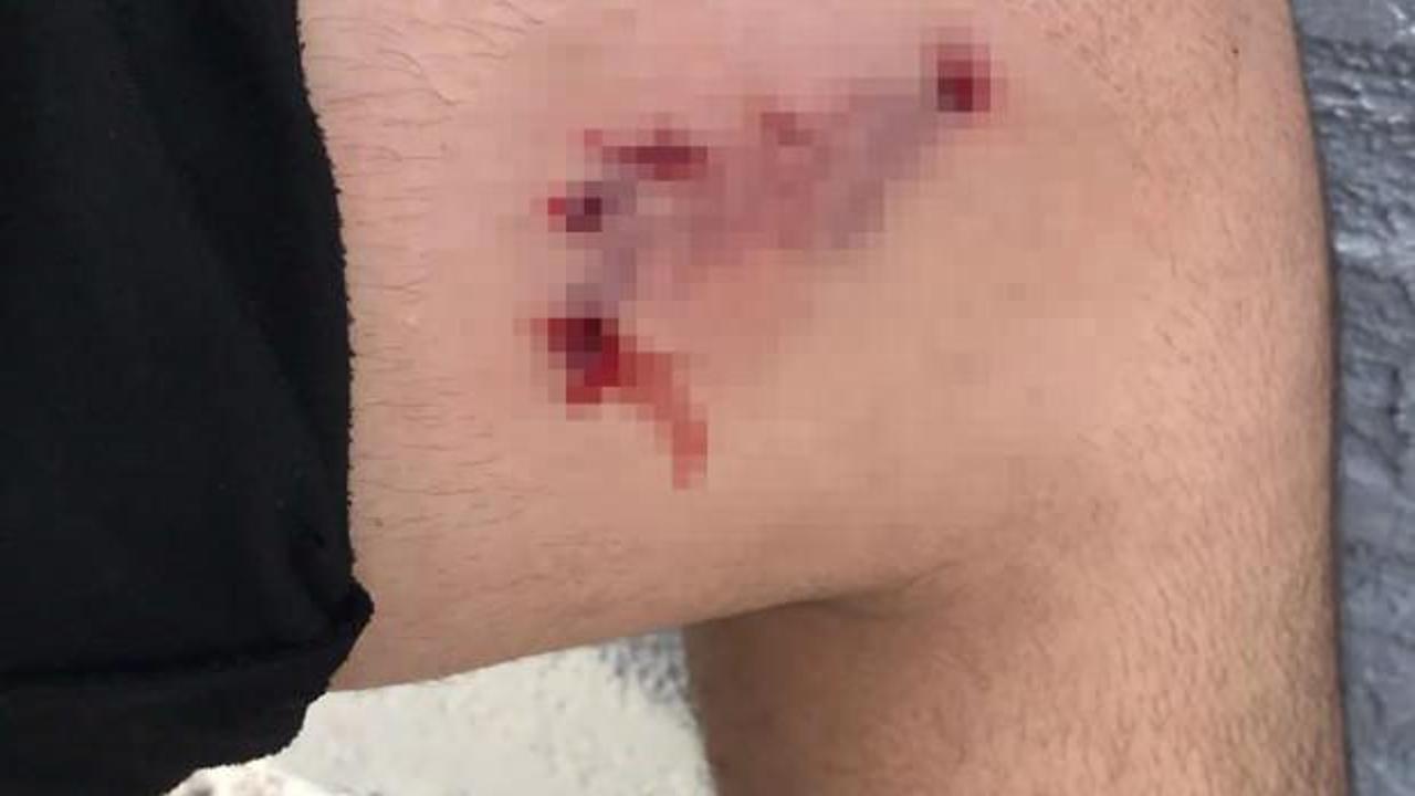 16 yaşındaki çocuk evine giderken başıboş köpeğin saldırısına uğradı!