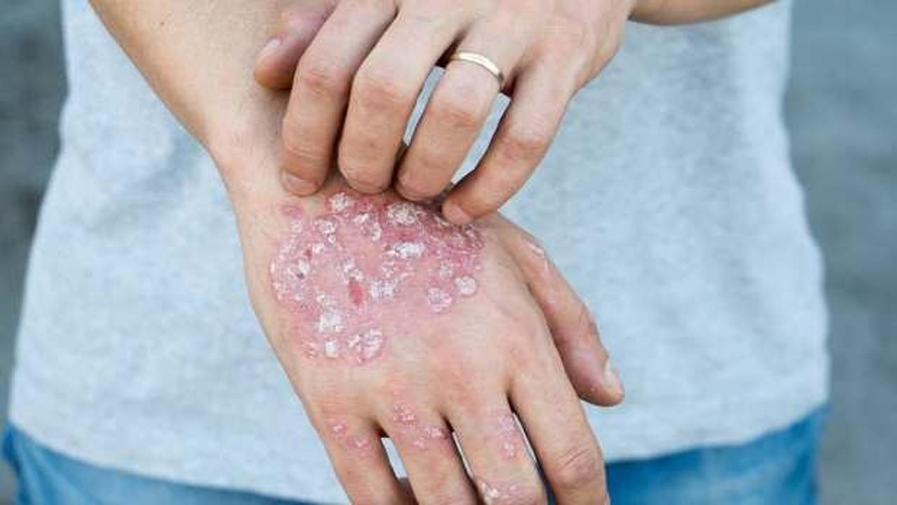 Uyuz vakaları yeniden artışa ge&ccedil;ti! En b&uuml;y&uuml;k problem ise...