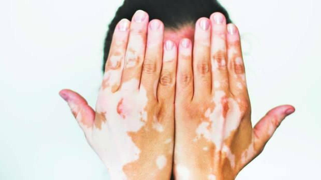 Sedef ve vitiligo için mucize krem! Jeoloji mühendisinin doğal buluşu!