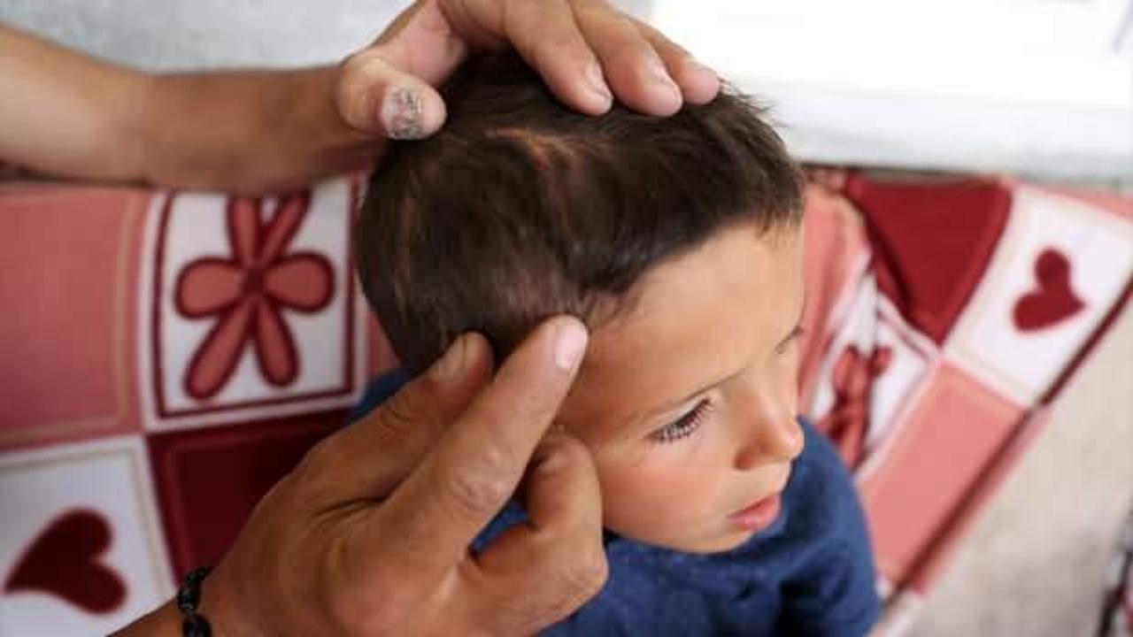 Başıboş k&ouml;peğin saldırısıyla 6 ameliyat ge&ccedil;iren Emir'in başında saldırının izleri kaldı