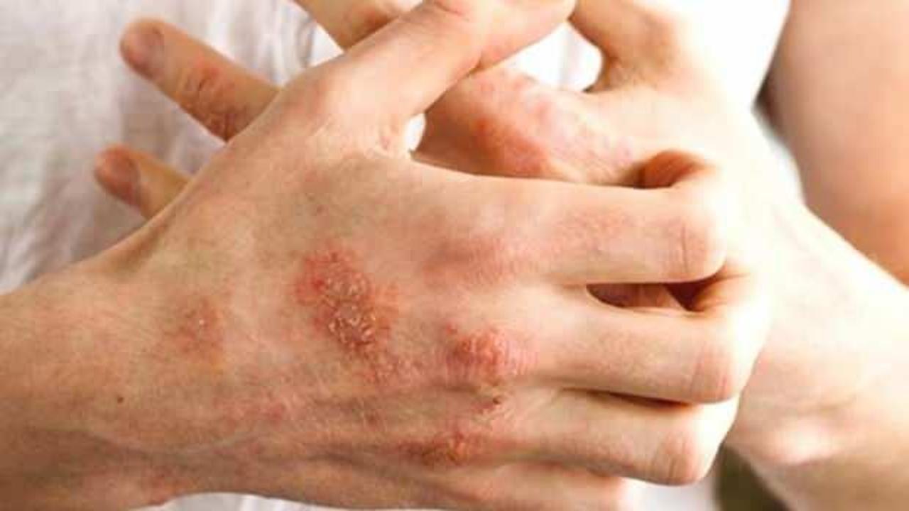 Egzamada çığır açan yeni tedavi yöntemi uygulanmaya başladı