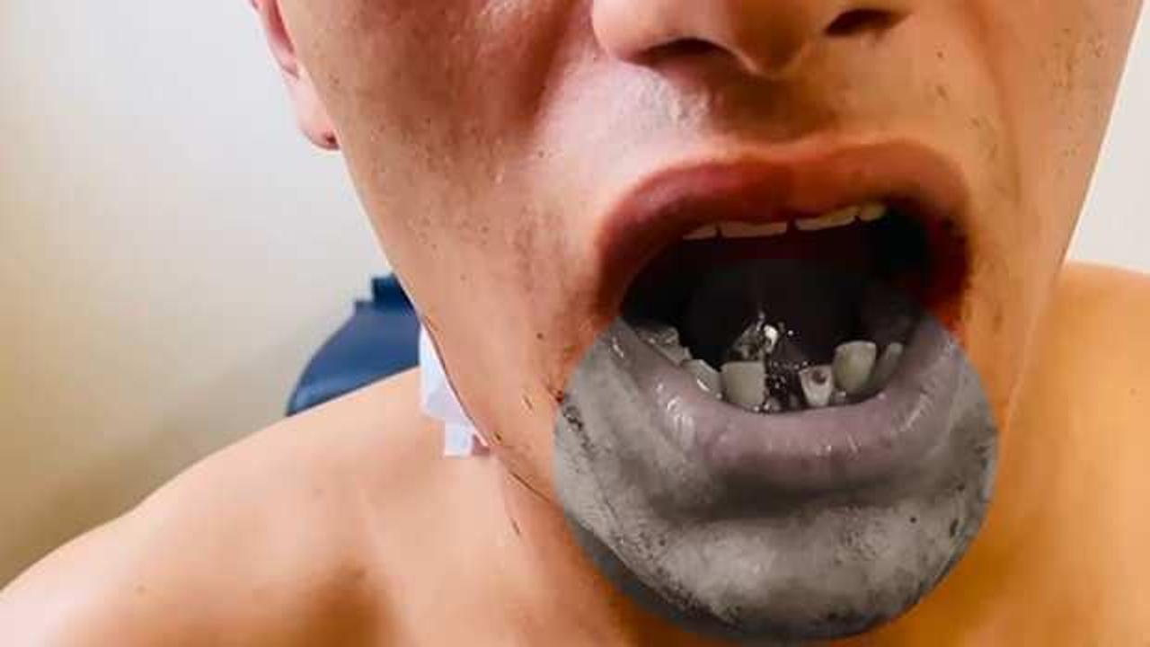 Yolda yürürken silahlı saldırıya uğradı! Boynundan giren mermi çenesine saplandı