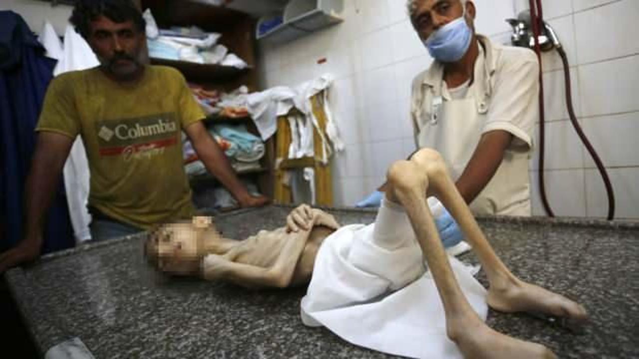  6 yaşındaki Filistinli Hikmet yetersiz beslenmeden hayatını kaybetti