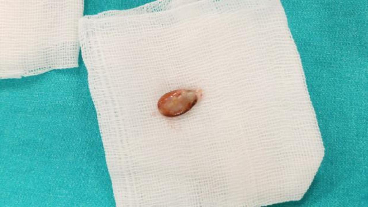 Doktorları şaşkına &ccedil;eviren vaka: Nefes borusundan 3 yıl sonra &ccedil;ıkarıldı!