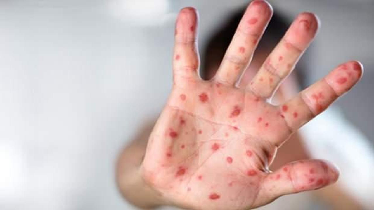 Türkiye'de 'maymun çiçeği' vakası var mı? Açıklama geldi