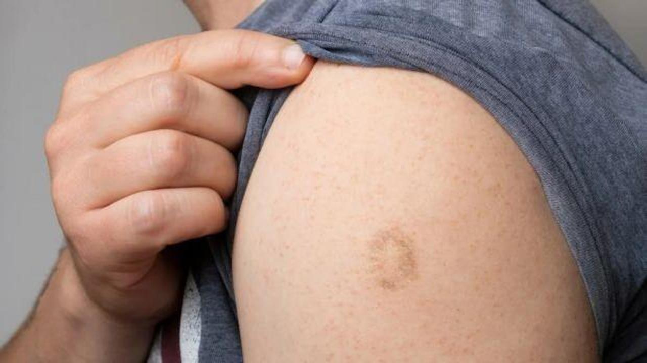 &Ccedil;i&ccedil;ek aşısı olanlar Maymun &Ccedil;i&ccedil;eği vir&uuml;s&uuml;ne karşı avantajlı mı?