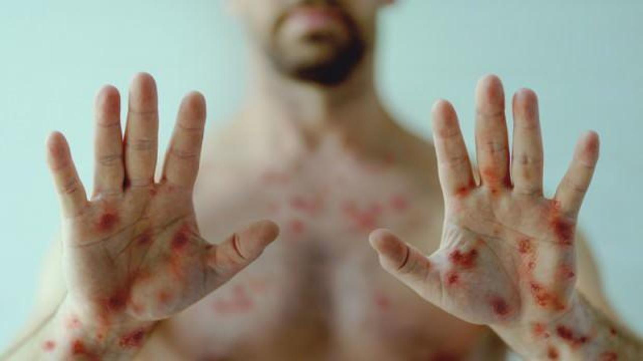 DS&Ouml;'den Maymun &Ccedil;i&ccedil;eği a&ccedil;ıklaması: Yeni Covid değil