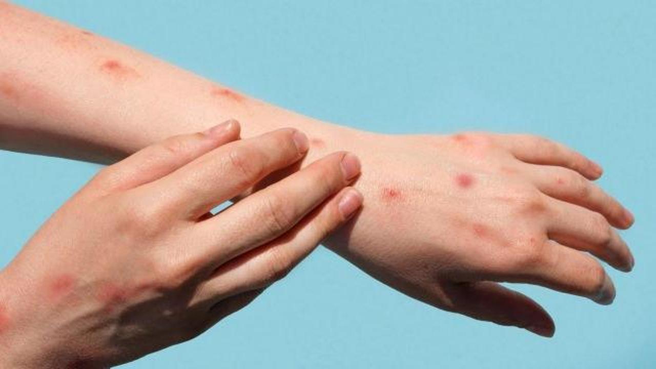 Sabri Ülker Vakfı, Maymun Çiçeği ile ilgili merak edilen soruları yanıtladı