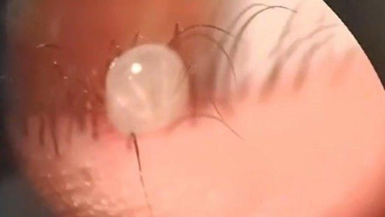 G&ouml;z&uuml;nden canlı kene &ccedil;ıktı