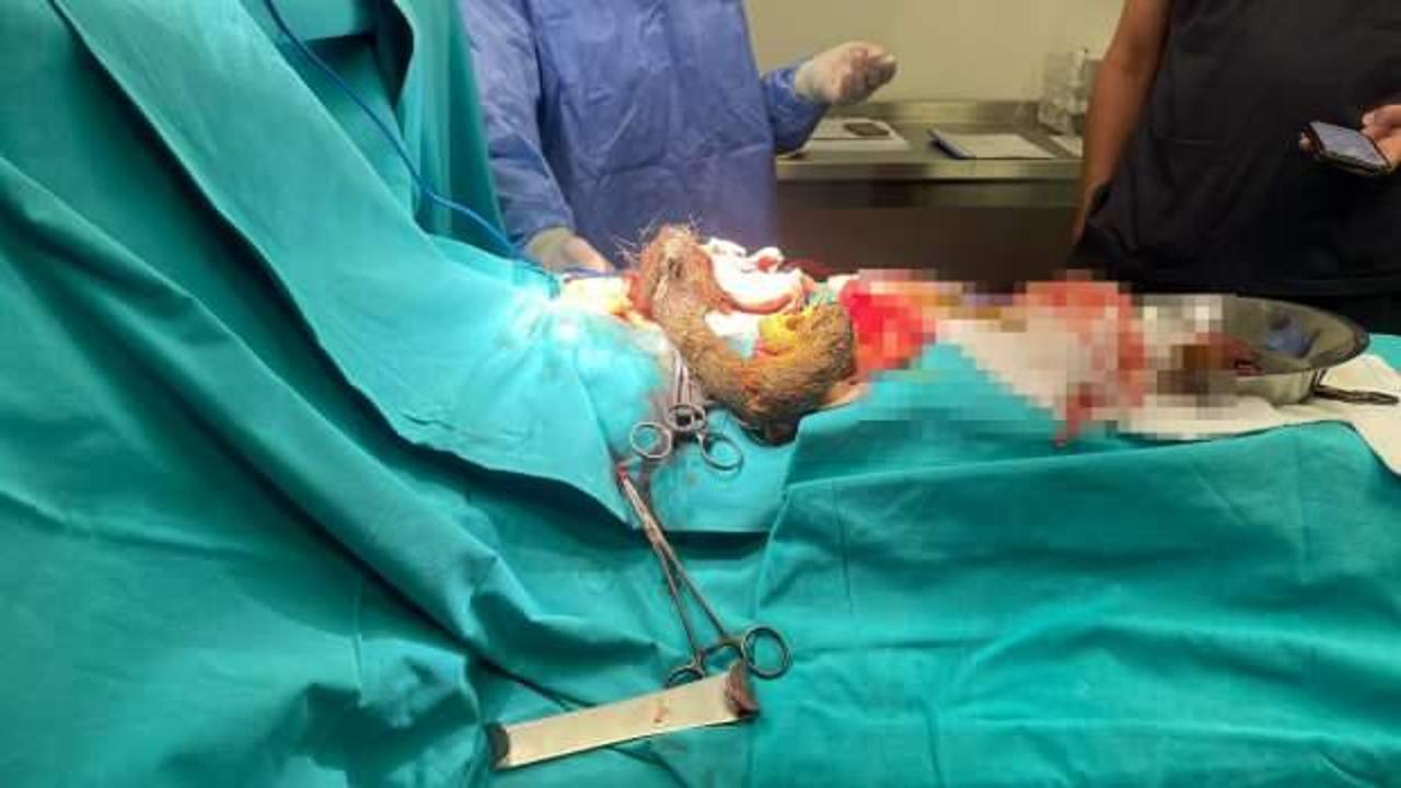 Hastanın midesinden &ccedil;ıkan şoke etti!