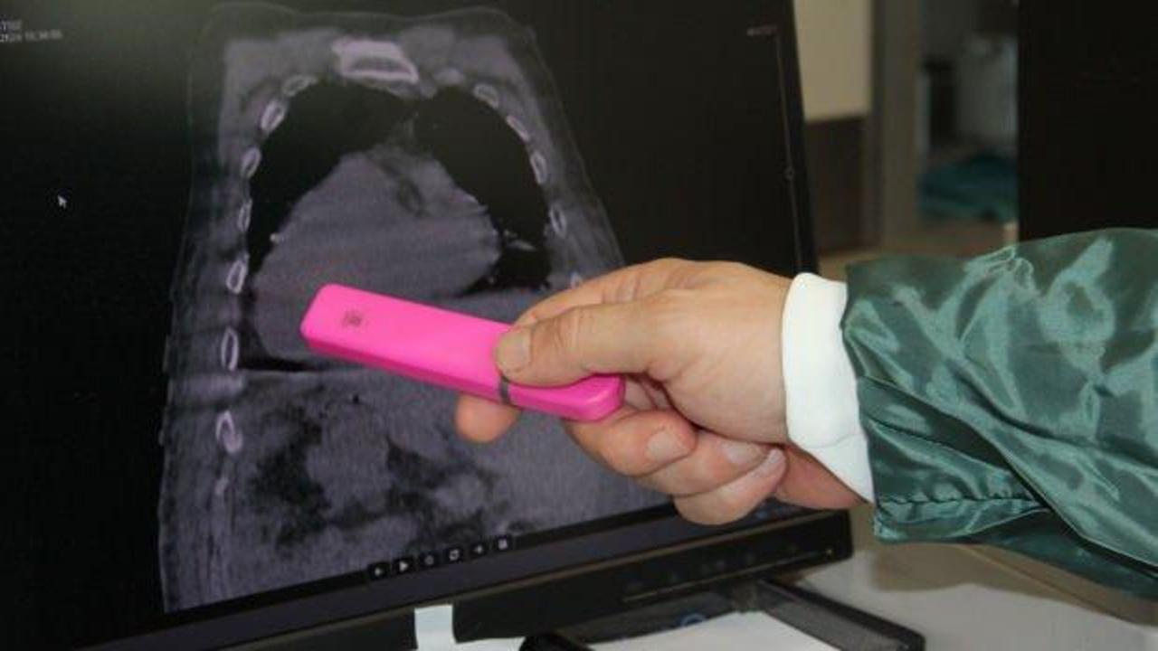 D&uuml;nyada bir ilk: T&uuml;m organları yer değiştirdi! 'Giresun Sendromu' adı verildi!