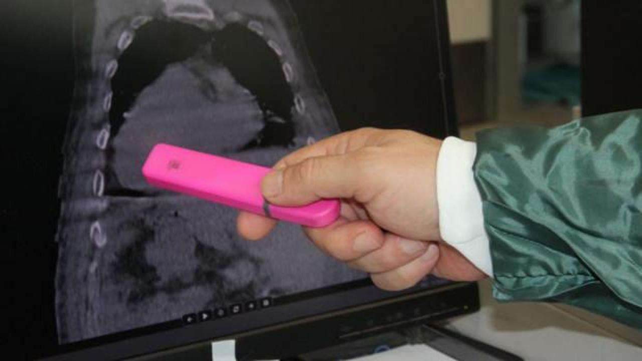 D&uuml;nyada ilk kez g&ouml;r&uuml;len 'Giresun Sendromu' tıp literat&uuml;r&uuml;ne girdi