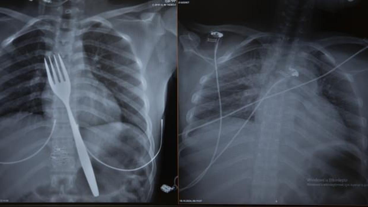 18 santimlik &ccedil;atal yuttu: Gen&ccedil; kız bilimsel makaleye konu olacak