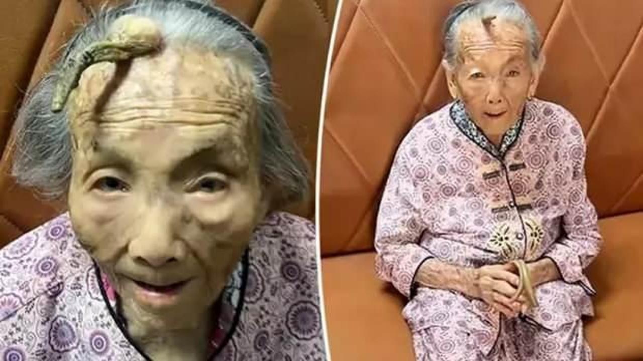 107 yaşındaki kadının kafasında boynuz &ccedil;ıktı