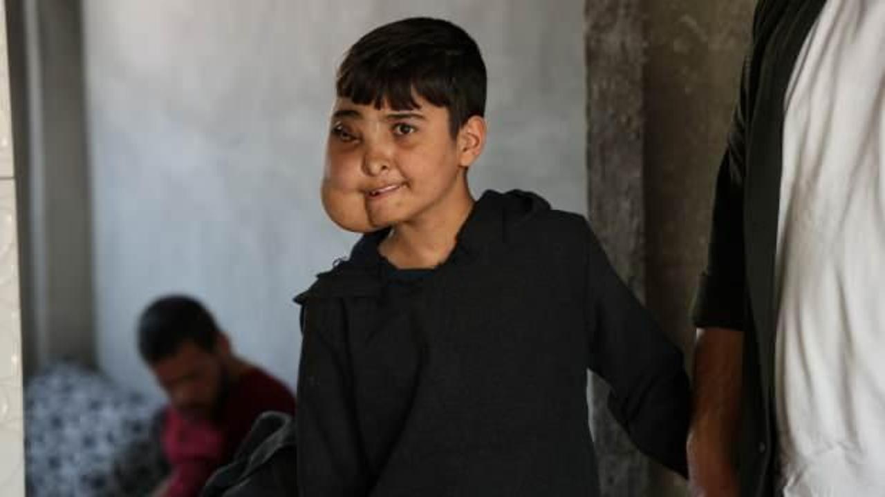 Milyonda bir g&ouml;r&uuml;len hastalık ile yaşıyor! Enes'ten iyi haber geldi 