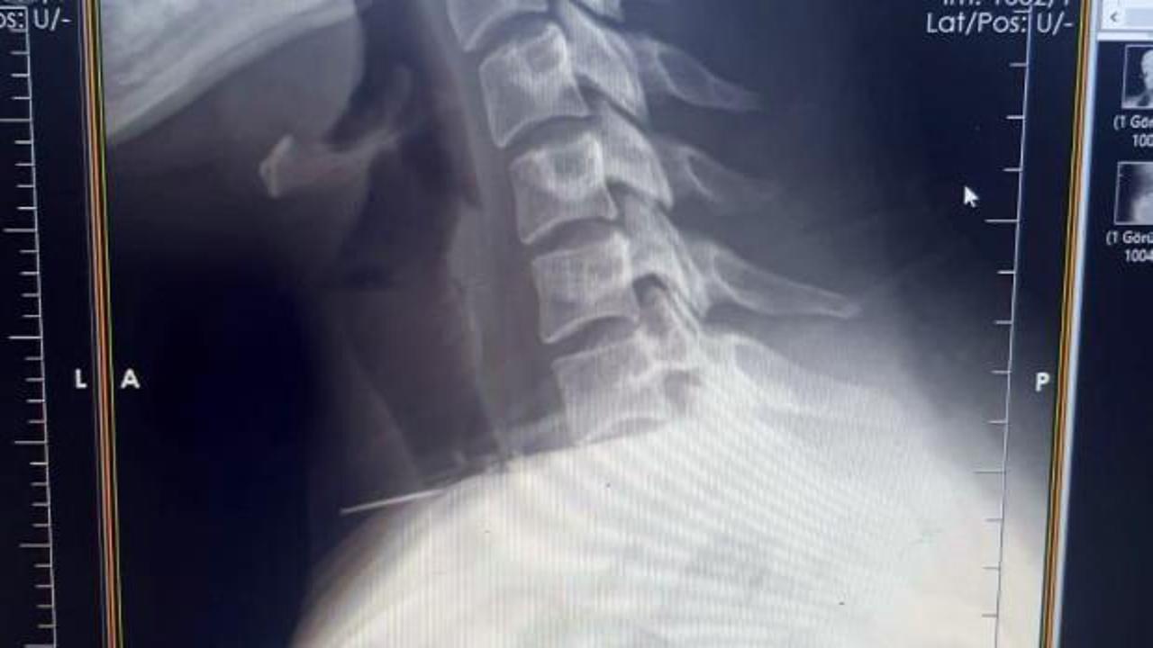 Baş&ouml;rt&uuml;s&uuml;n&uuml; takarken boğazına iğne saplandı!