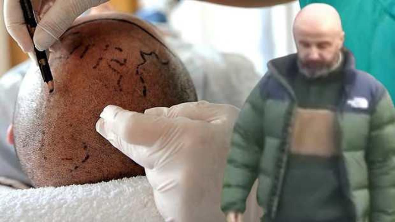 Sa&ccedil; ektirmeye gitti, kulak zarı patladı