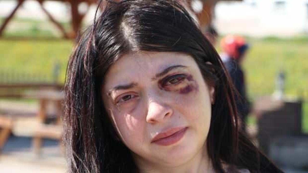 Sokak ortasında dehşeti yaşadı! 3 ay sıvı ile beslenecek 