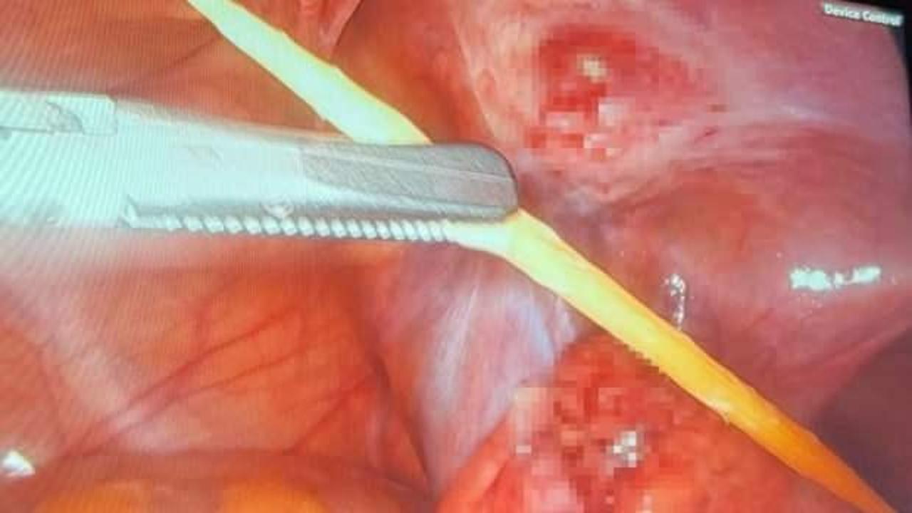 17 yaşındaki hasta ölümden döndü! Kalın bağırsağını delen cisim başarıyla çıkartıldı