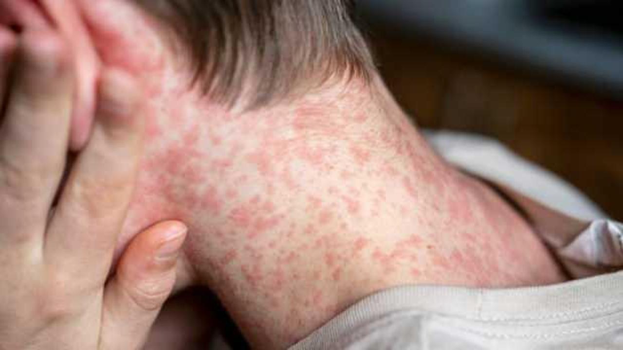 ABD'de kızamık alarmı! Vaka patlaması