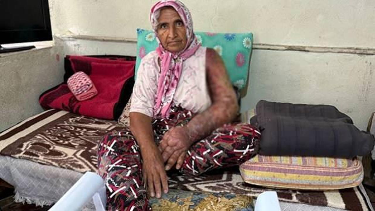 8 yıl &ouml;nce başlayan o ağrı kabusu oldu! Kolunun kesilmesi gerektiğini &ouml;ğrendi