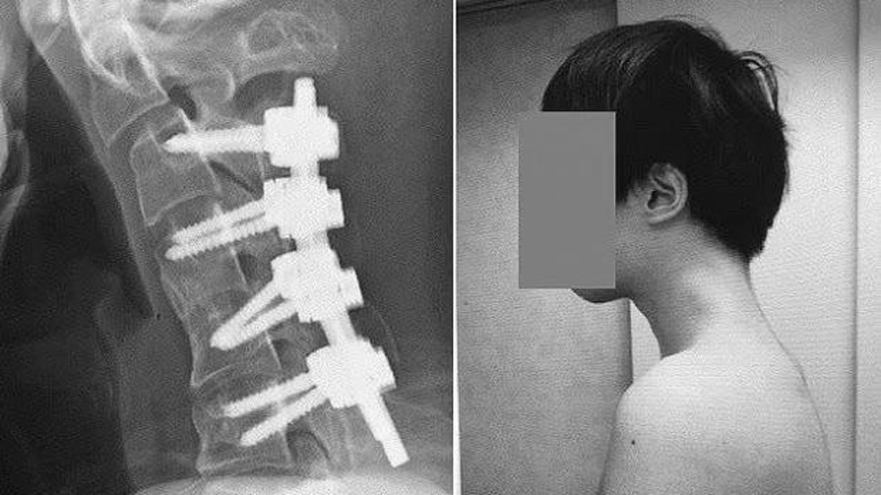 Tıp d&uuml;nyasında yeni bir terim: D&uuml;ş&uuml;k Kafa Sendromu