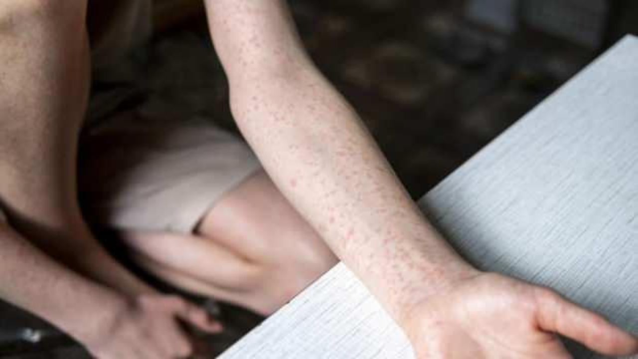 ABD'de bir kızamık alarmı daha!