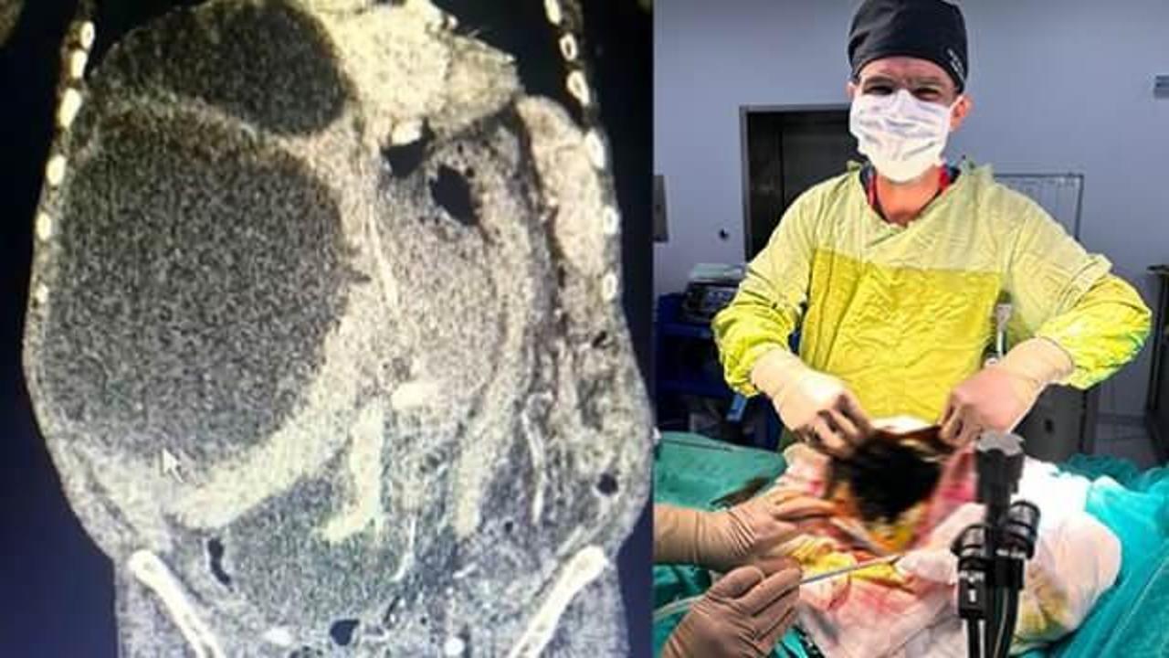 Doktor şaştı kaldı: Dünya literatüründe yok! 90 santimetrelik kedi-köpek kisti çıkarıldı!