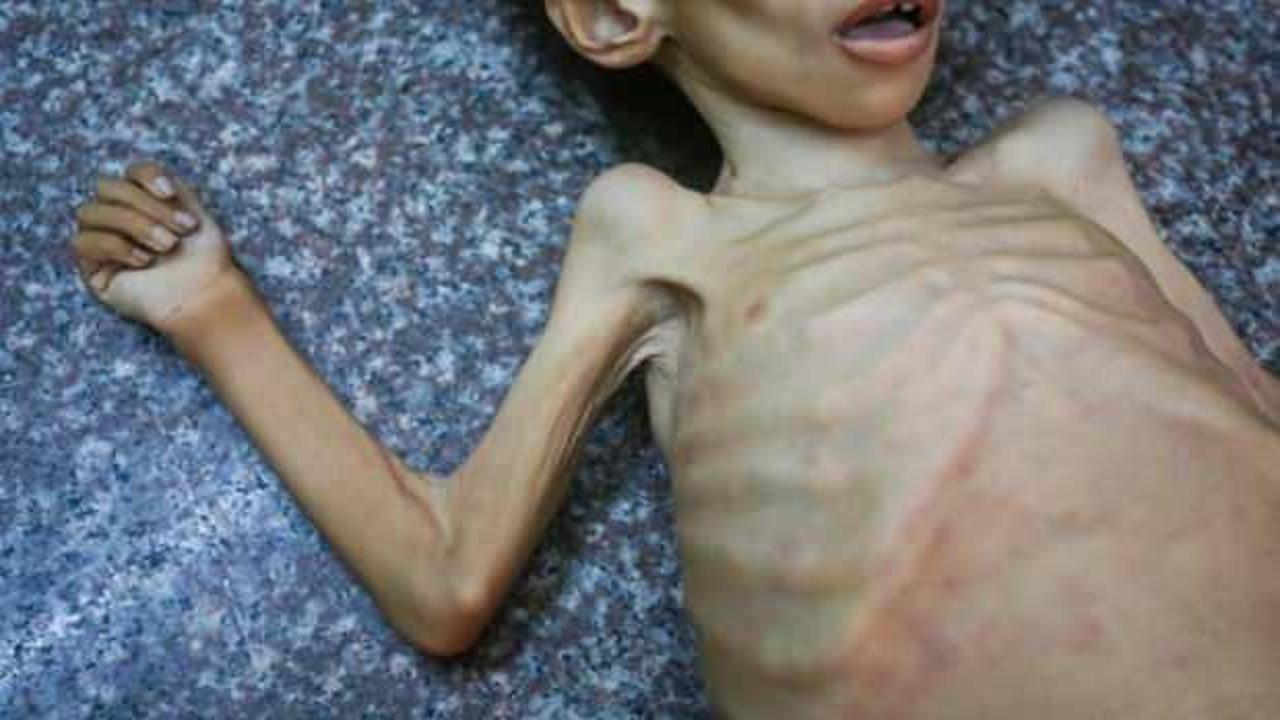 Gazze'de bir &ccedil;ocuk daha a&ccedil;lık nedeniyle hayatını kaybetti