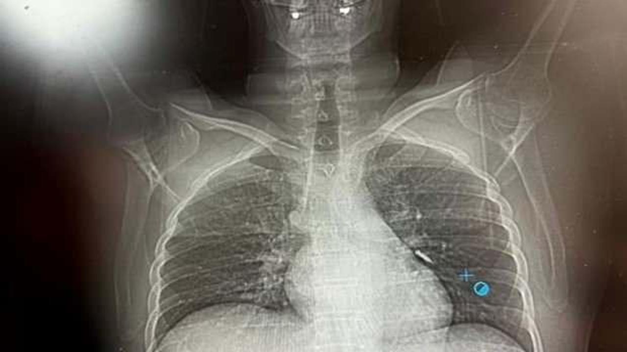 İmplant vidası ciğerine ka&ccedil;an hasta &ouml;l&uuml;mden d&ouml;nd&uuml;