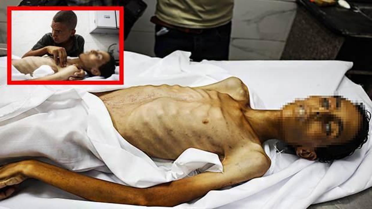 Gazze'de açlıktan şehit olanların sayısı 175'e çıktı