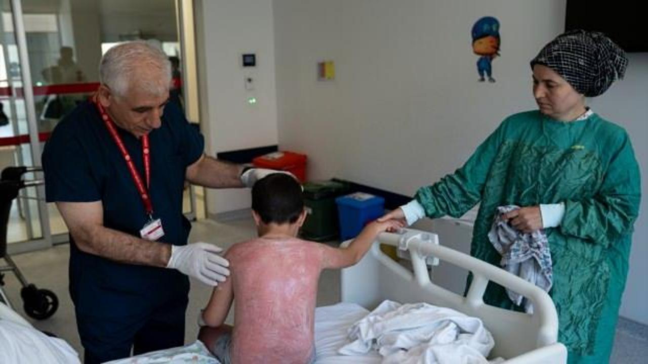 Güneşin altında 4 saat kalan çocuk, ikinci derece yanık oldu