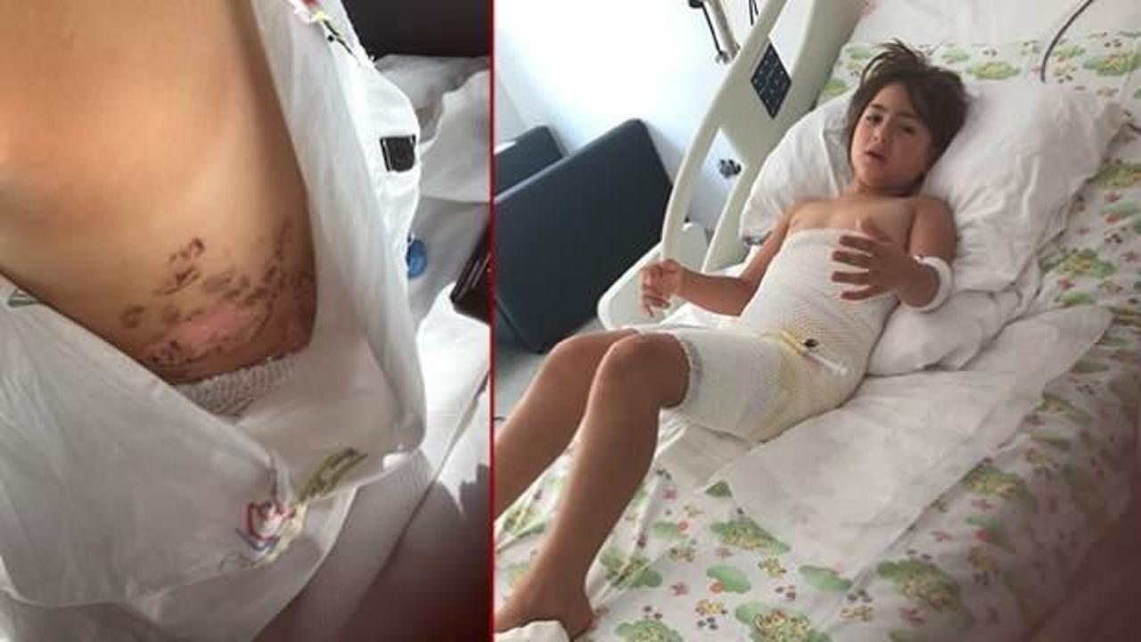 Nevşehir'de düğün faciası! Vücudu donan Elif, 7 operasyon geçirdi