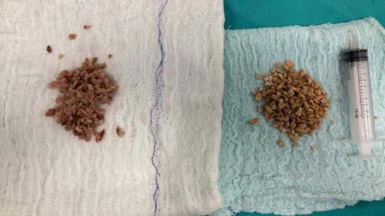 84 yaşındaki hastanın mesanesinden çıktı!