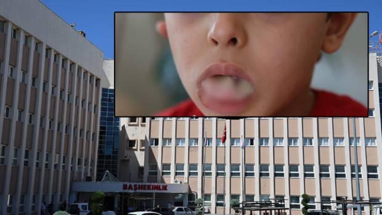 5 yaşındaki çocuk ameliyatta dehşeti yaşadı: Dili ve dudağı yandı