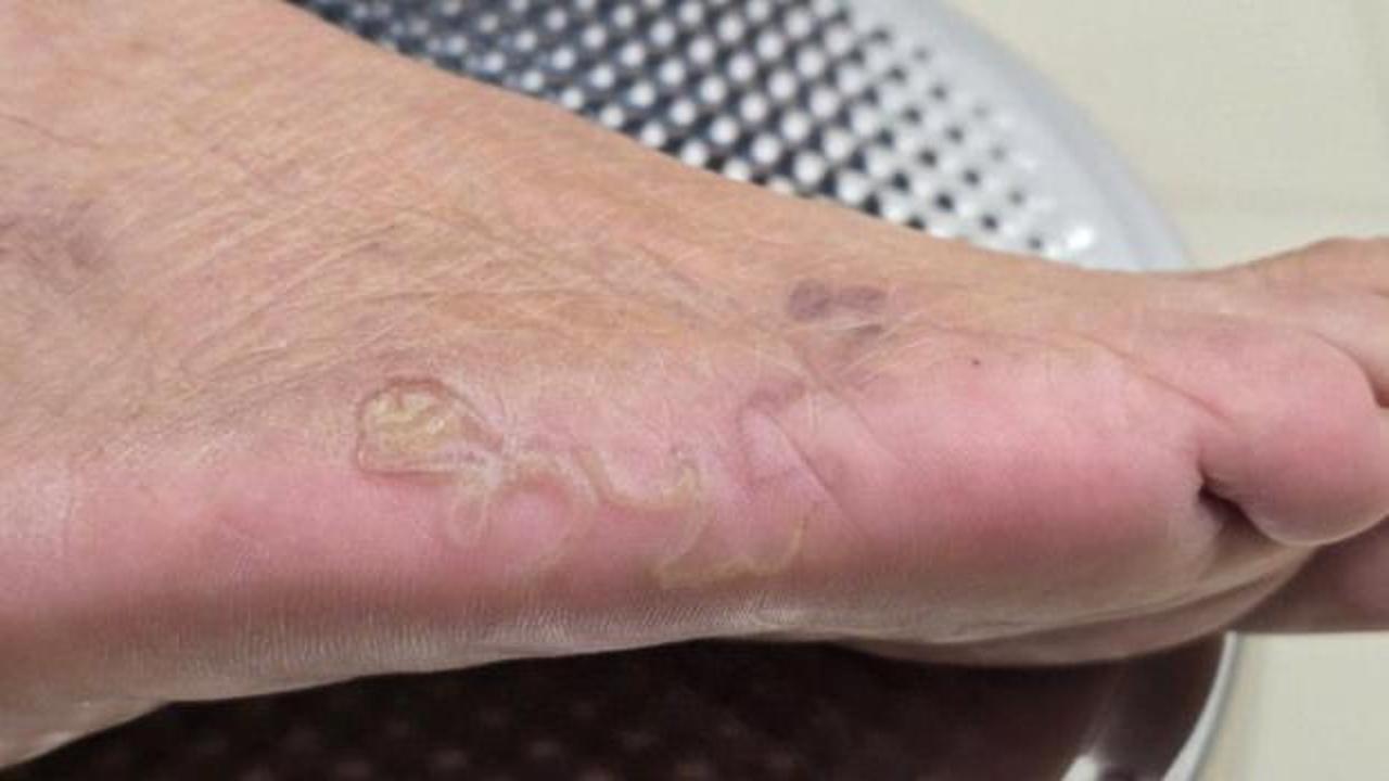 Çıplak ayak gezmek bile yasakalanmıştı: Rize’deki bu hastalık 1980’den beri görülmedi