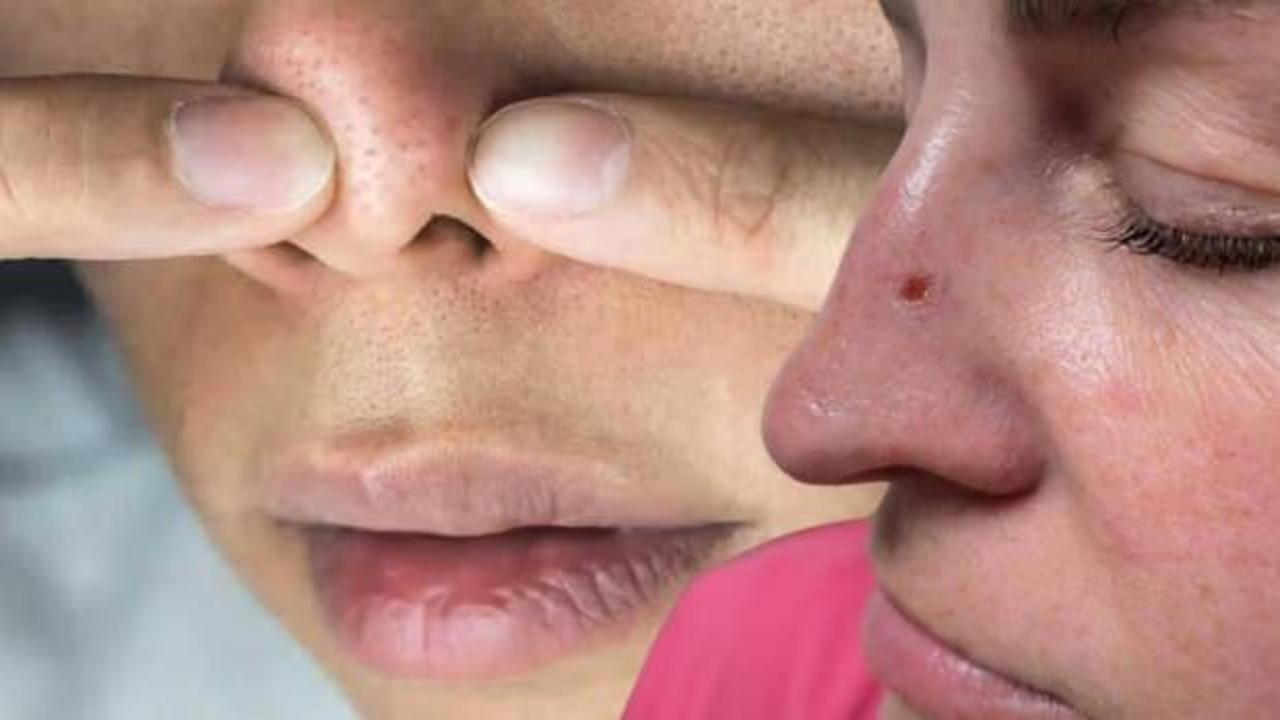 Cilt kuruluğu sandı, kanserle karşılaştı: Bu hatayı sakın yapmayın!