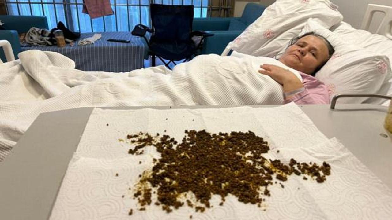 Doktorlar şoke eden vaka: Safra kesesinden 20 binin üzerinde taş çıktı! İşte o görüntü...