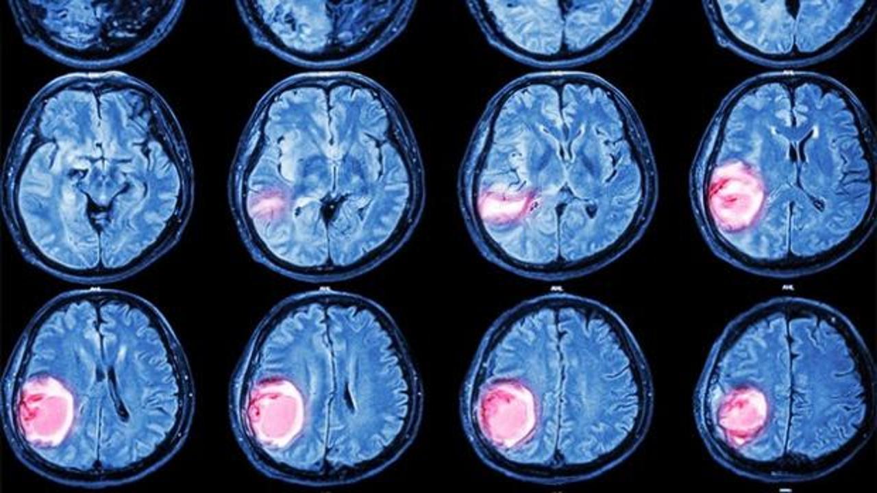 Beyin tümörlerinde 3 kritik sinyal!