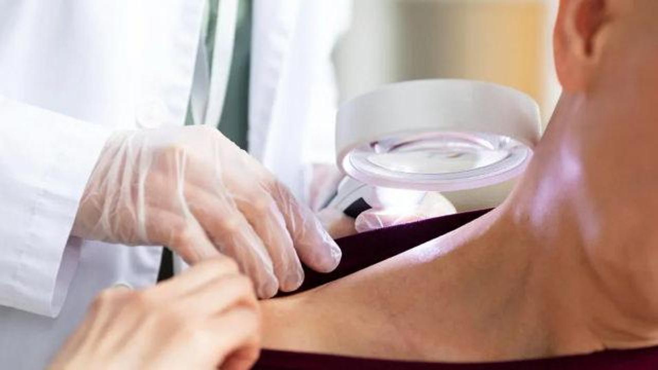 Cilt kanseri riskini 3 kata yakın artırıyor! Pop&uuml;ler diye yapmayın