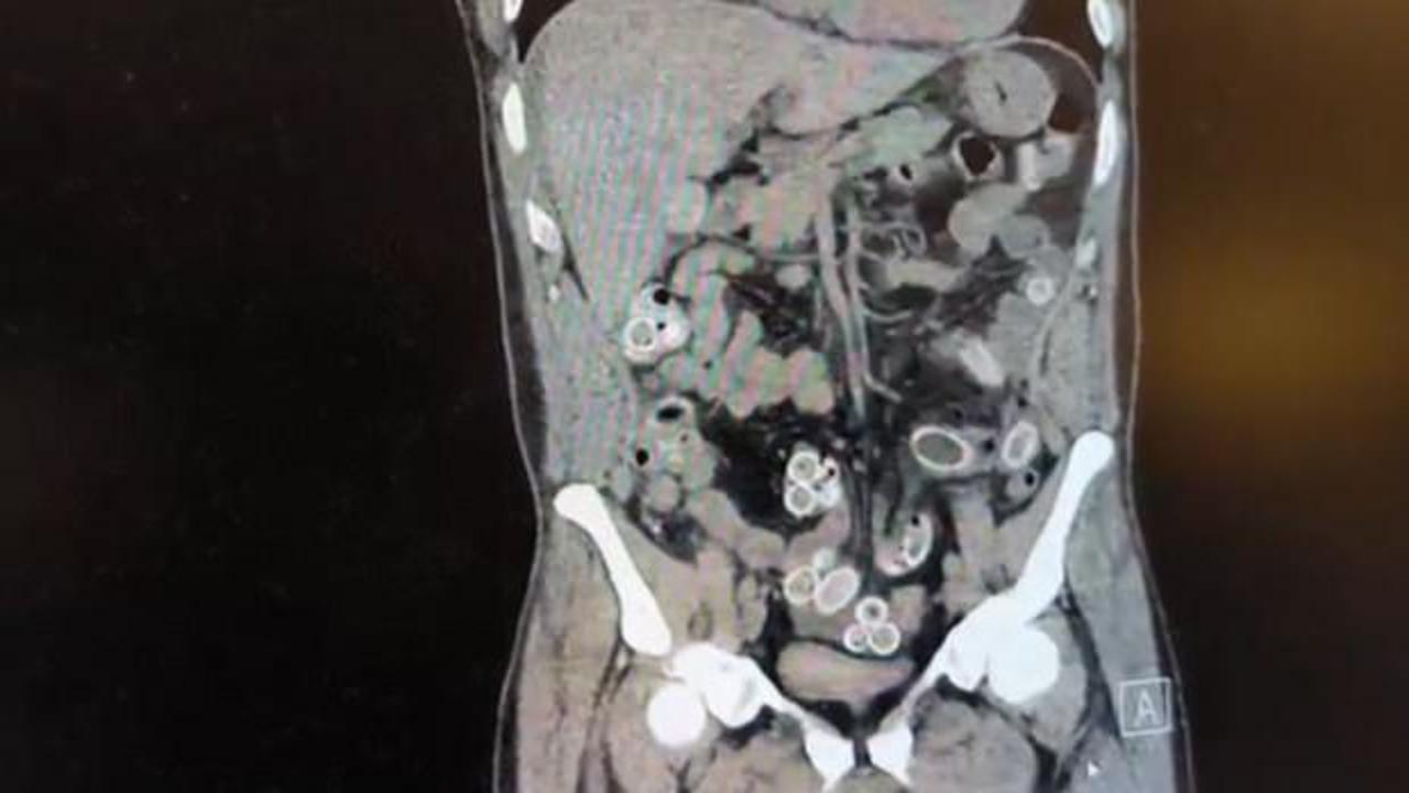 Fas&rsquo;tan Beşiktaş'a midesinde uyuşturucu getirdi: Ameliyatla &ccedil;ıkarıldı 