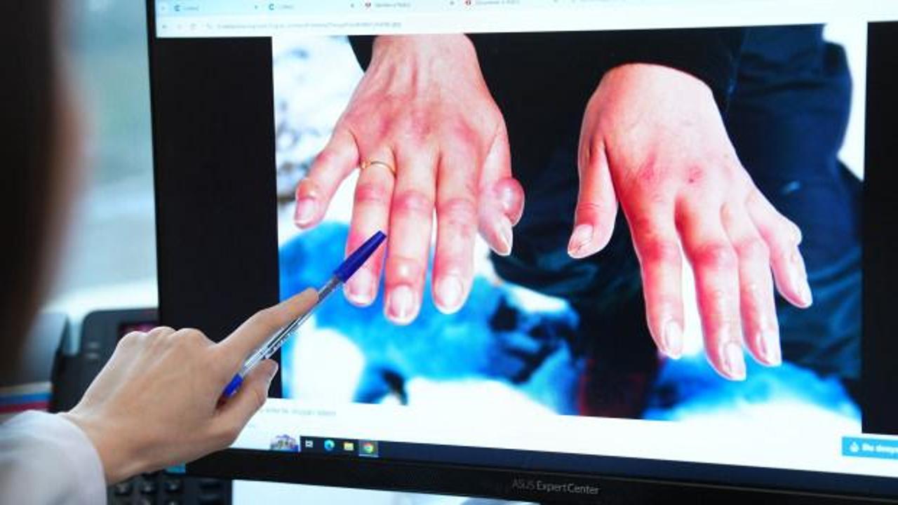 Kış geldi, risk arttı soğuk ısırığına dikkat