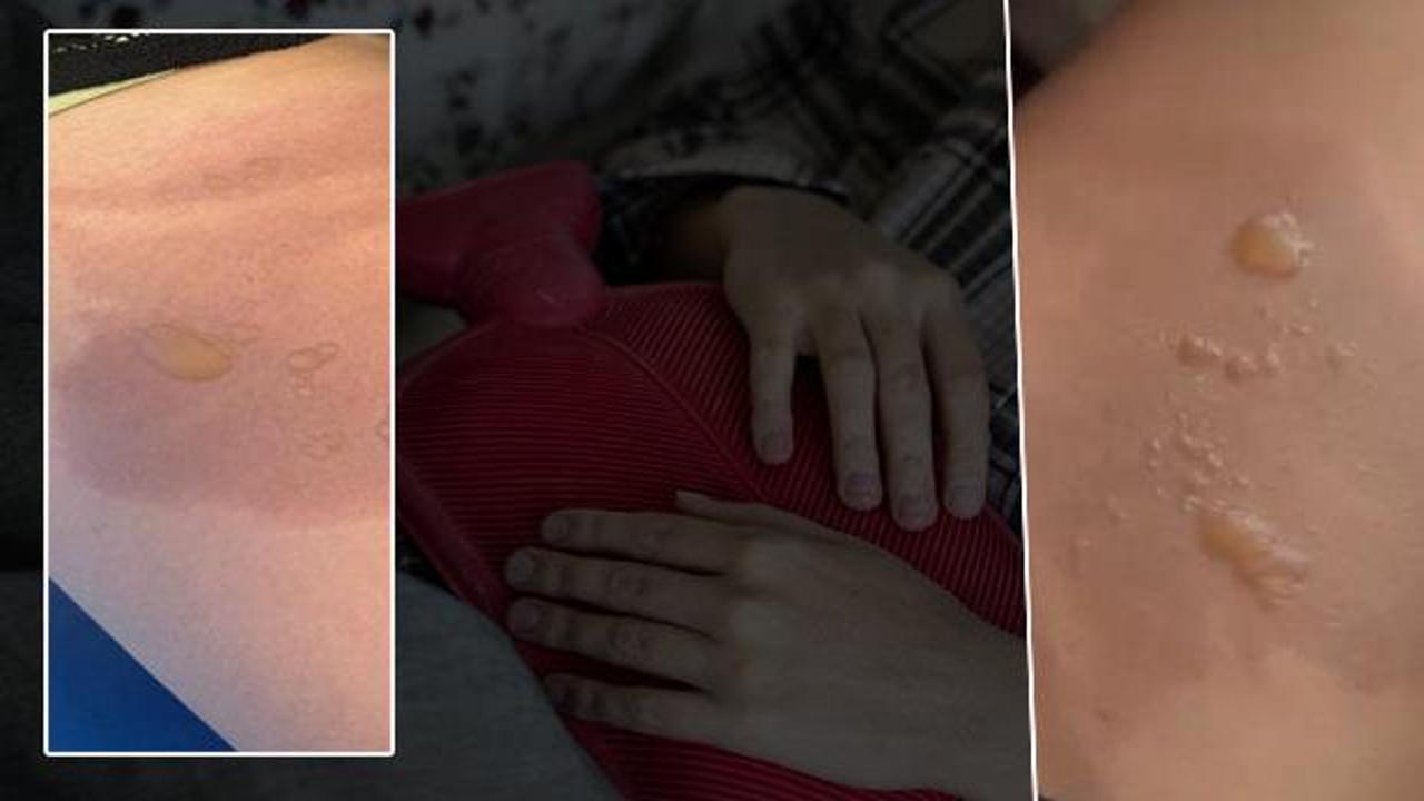 Yine sıcak su torbası yine facia: 3 dakika sonra patladı!