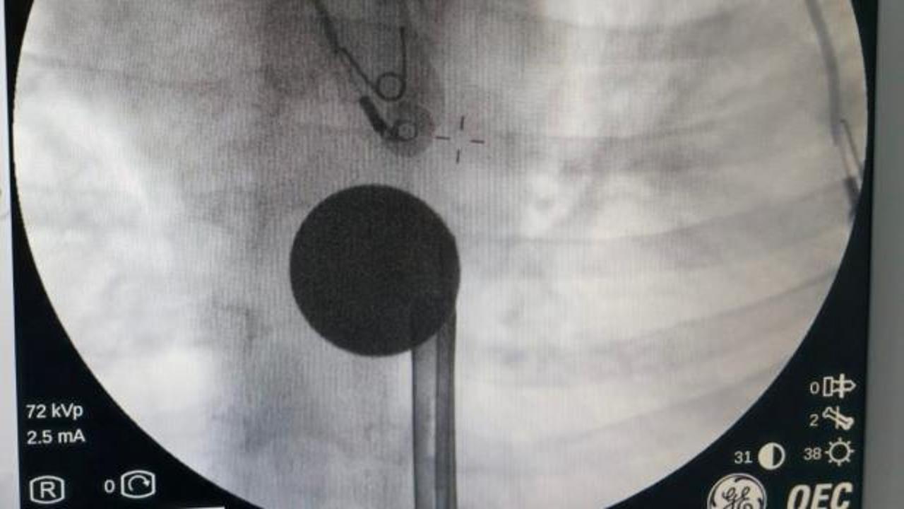 G&ouml;ren inanamadı! 8 yaşındaki &ccedil;ocuğun boğazından &ccedil;ıkartılan şaşırttı