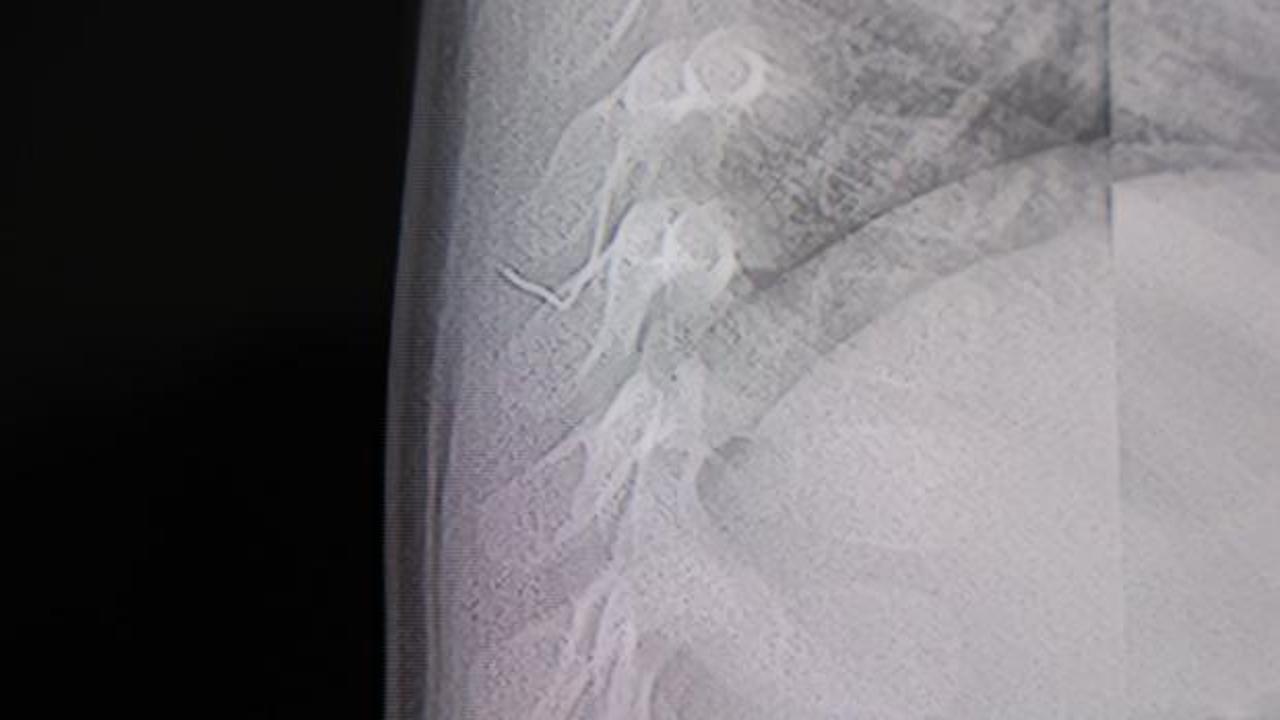 Sırt üstü yatınca ağlıyordu! 1 yaşındaki bebeğin vücudundan çıkan cisim şoke etti