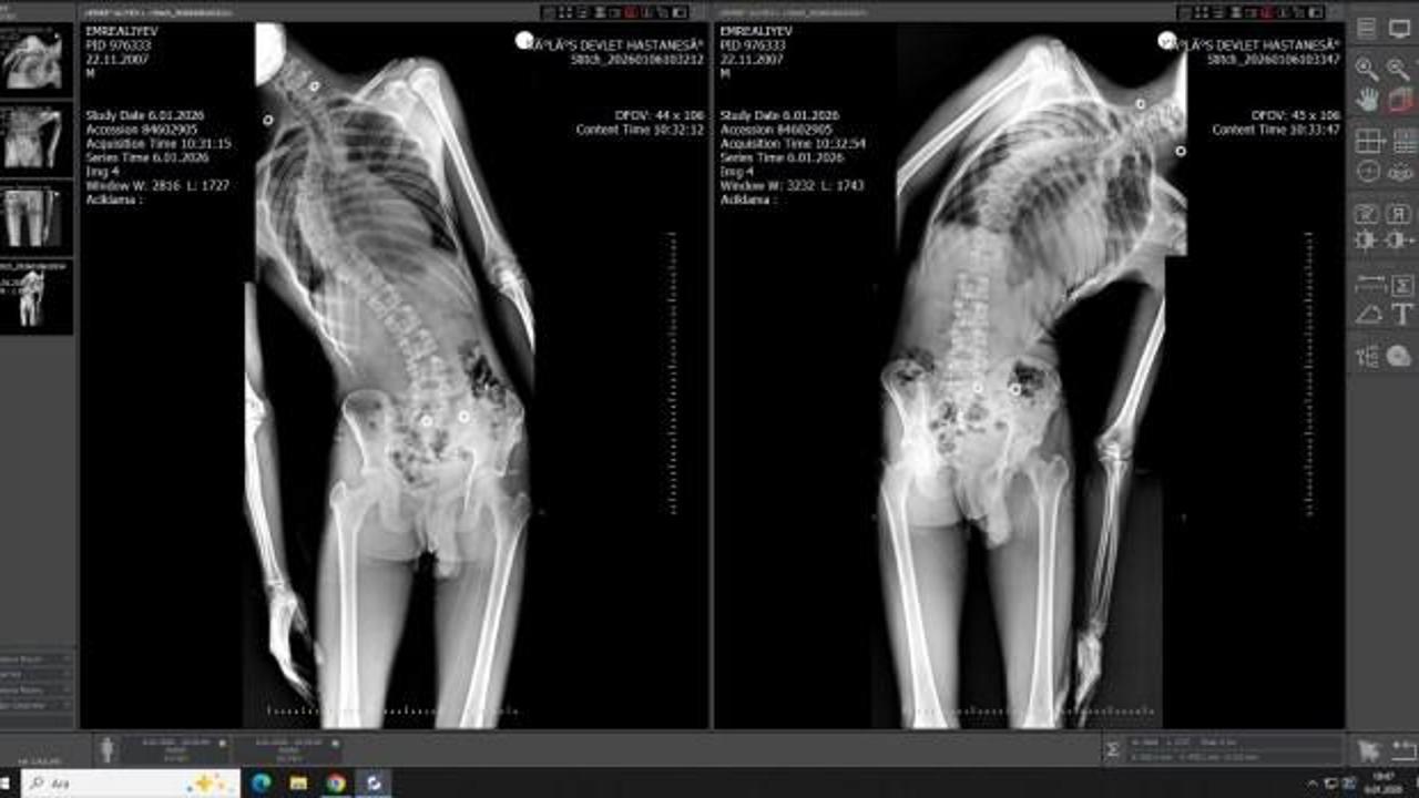 Mersin'de &ouml;nemli başarı: 18 yaşındaki gencin boyu ameliyatla 4 santimetre uzadı
